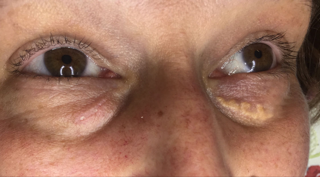 Xanthelasma removal