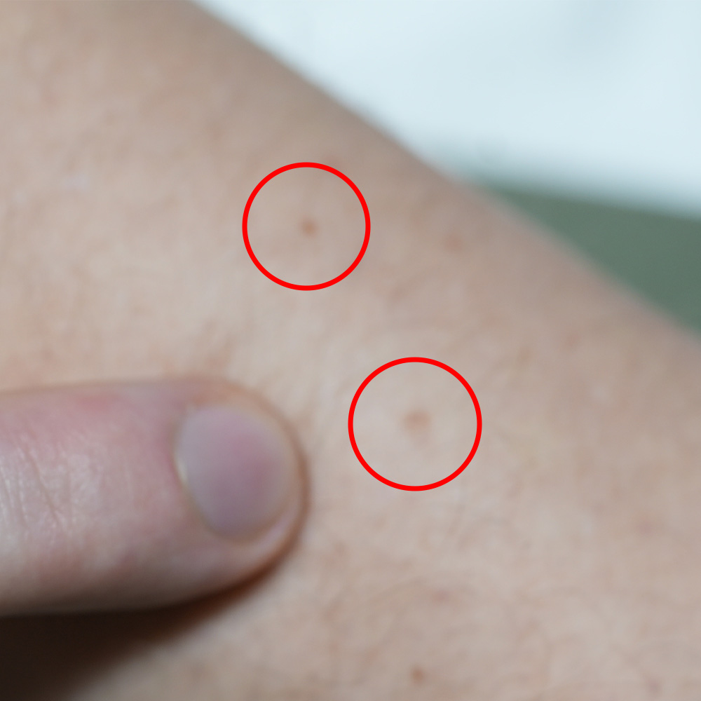 Altersflecken vor Behandlung