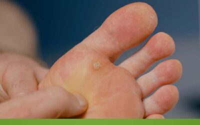 Warzen-Entferner-Stifte – Was Sie wissen sollten