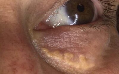 Xanthelasmen entfernen – helfen Salben oder Hausmittel wirklich?